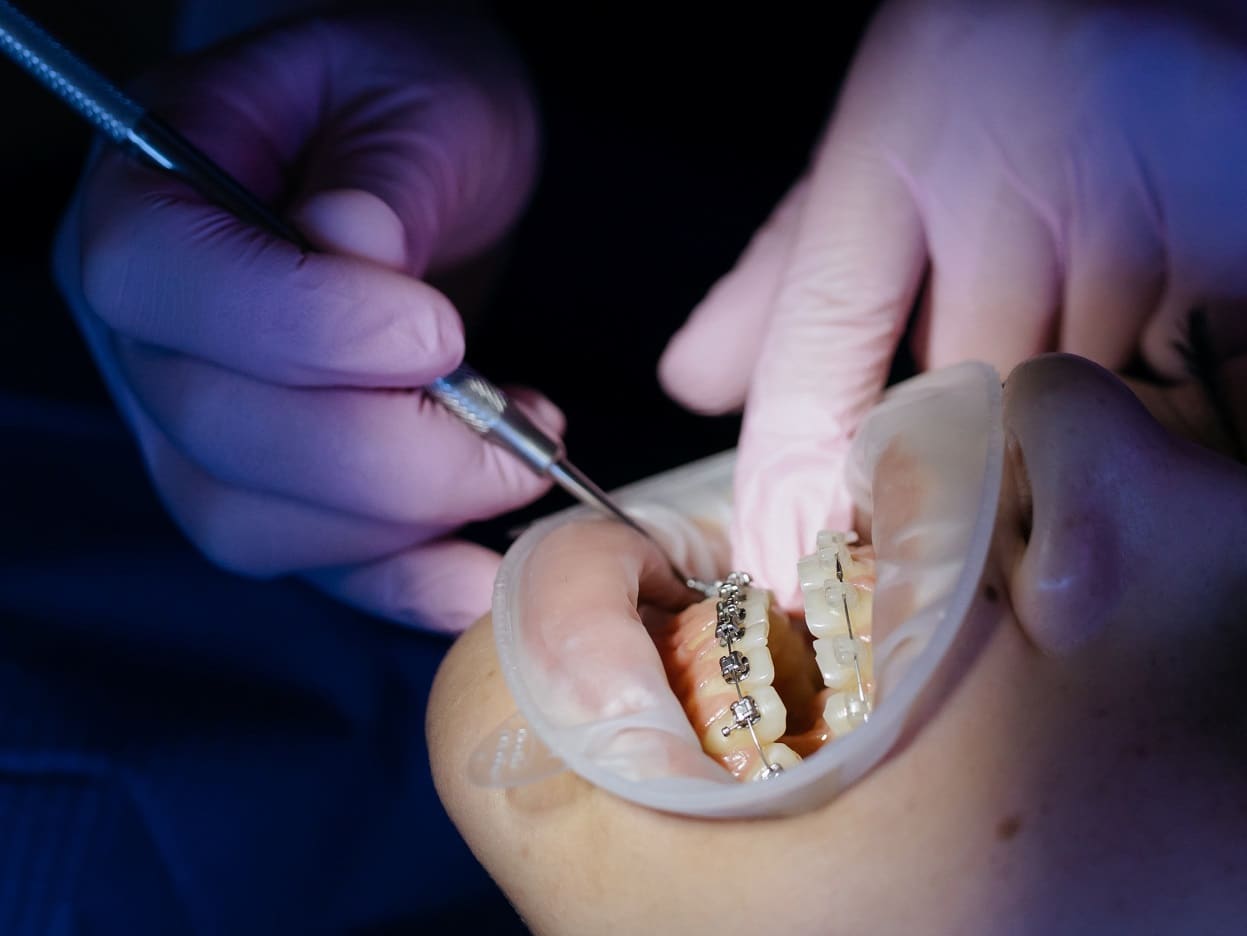 Ekstruzja zęba – co to jest, leczenie, cena